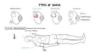 Approach to Shock  types hypovolemic cardiogenic distributive anaphylaxis pathology treatment [upl. by Livi]