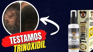 Testei O Trioxidil Funciona Mesmo Trioxidil ANTES E DEPOIS Trioxidil Resultados [upl. by Ahsiemat27]