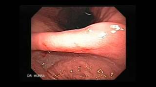 Video clip of an Upper Endoscopy [upl. by Nnayd]