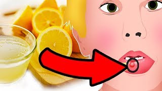 Natural Cures for Mucocele Mucous Cyst  How I treat it [upl. by Beaver]