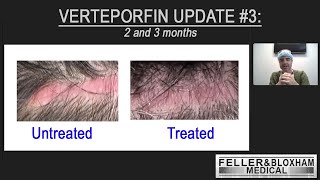 Verteporfin Update 3 Month 2 and 3  Dr Blake Bloxham  Feller amp Bloxham Medical  NYC LI [upl. by Netsirhc760]