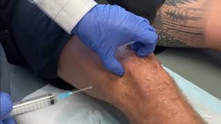 KNEE Intraarticular injection of Local Anaesthetic and Steroid [upl. by Bocock]