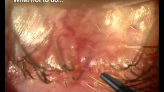 Demodex Blepharitis Is it for real [upl. by Canotas]