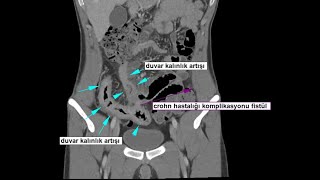 BTde bağırsak duvar kalınlık artışı bowel wall thickening [upl. by Pape273]