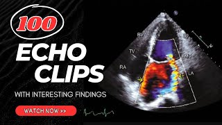 100 Echocardiography Clips with Interesting Findings [upl. by Neivad]