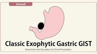 Classic Exophytic Gastric GIST [upl. by Eimmas]