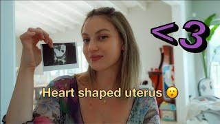 Do you have a Heart Shaped Uterus Bicornuate uterus [upl. by Euqinaj]