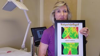 Thermography and Breast Health [upl. by Thoma451]