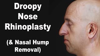 Droopy Nose Rhinoplasty and Nasal Hump Removal [upl. by Kimbell]