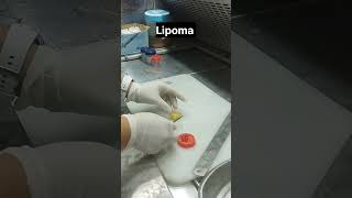 lipoma lipomatreatment [upl. by Akered914]