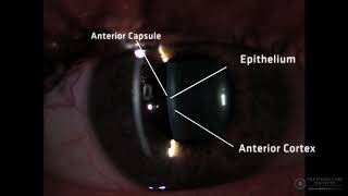 Slit Lamp Techniques Optical Section of Crystalline Lens [upl. by Lafleur]