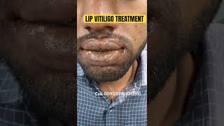 100 lip VITILIGO PERMANENT TREATMENT VITILIGO lip SAFED DAAG  lipvitiligotreatment shorts cure [upl. by Rohn604]