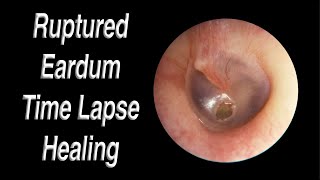 Ruptured Eardrum Healing Closed Time Lapse  A Hole in Eardrum Usually Heals Closed on Its Own [upl. by Refiffej]