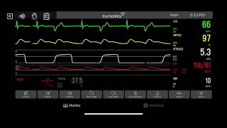 Electrical Alternans [upl. by Channing655]