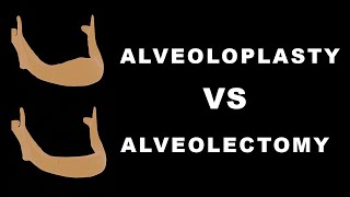 Alveoloplasty vs Alveolectomy [upl. by Assehc497]