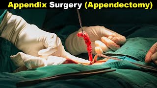 How Does Appendectomy Works  Appendicitis treatment UrduHindi [upl. by Llenyt96]