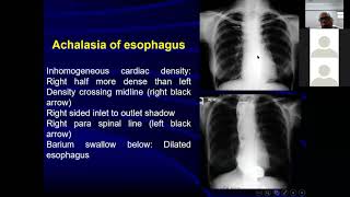 radiological signs of chest diseases part 1 [upl. by Araht]