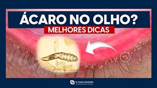 Blefarite e Demodex como tratar  Dr Gustavo Bonfadini [upl. by Viens]