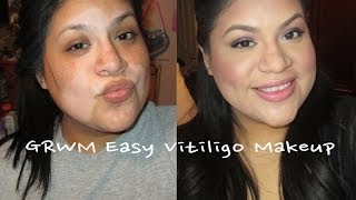 GRWM Easy Vitiligo Make Up [upl. by Matthia396]