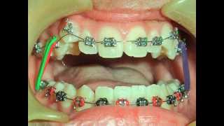 ORTHODONTIC TREATMENT NO 12  Class 1 CROWDING [upl. by Nnairet]