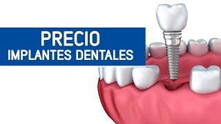 Implantes dentales precio Odontoespecialistas [upl. by Onabru]