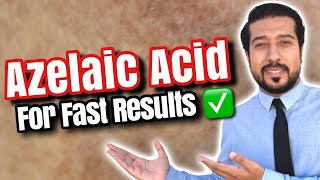 Azelaic Acid for Melasma  How to Use Azelaic Acid for SUCCESS 🏆 [upl. by Delia]