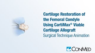 Cartilage Restoration of the Femoral Condyle Using CartiMax®  CONMED Animation [upl. by Ymaral85]