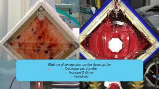 ECMOextracorporeal membrane oxygenation circuit part 2 [upl. by Llehcal]