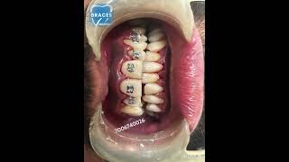 Class 2 div 1 Malocclusion  BRACES trending dentist toothdental dentalcare dentalclinic tooth [upl. by Artcele]