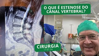 O que é estenose do canal vertebral A cirurgia endoscópica é indicada para este caso  170724 [upl. by Erised]