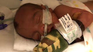 Premature Micro Preemie Baby Born At 23 weeks  He Can Breathe ON HIS OWN [upl. by Ysak]