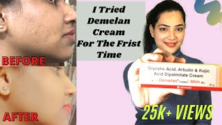 DEMELAN CREAM REVIEW  हिंदी में  My 1 Month Experience With Demelan Cream  Skin Lightening Cream [upl. by Hirsh237]