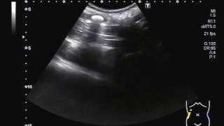 Ultrasound Video showing scanning of Ureteric stone with different body positions and Probes [upl. by Ayrotal]