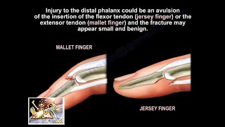 Mallet and Jersey Fingers Description Everything You Need To Know  Dr Nabil Ebraheim [upl. by Otir83]