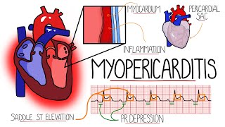 Myocarditis amp Pericarditis Myopericarditis Explained [upl. by Bendicta832]