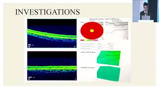 AIOC2024 GP199 topic Dr Markandeya Singh Foveal Aplasia [upl. by Anivel]