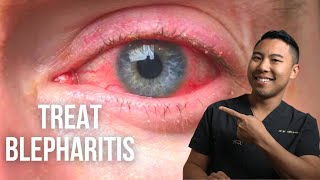 How to treat blepharitis 3 ScienceBacked Ways  OphthalmologistMichaelRChuaMD [upl. by Dagley663]