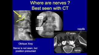 UCSF Radiology Common Spine Injection Procedures [upl. by Carmella]