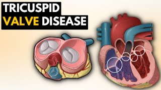 Tricuspid Valve Disease Causes Signs and Symptoms Diagnosis and Treatment [upl. by Farhi]