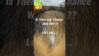 PRP Hair Loss Treatment Before and After  PRP Results [upl. by Fineberg329]