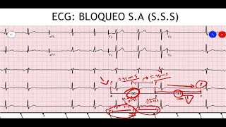 ECG BRADIARRITMIAS  Disfunción del Nodo Sinusal SSS  PARTE 3 [upl. by Lillie]