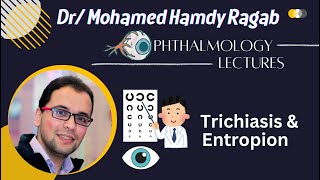 Eyelid 3 Trichiasis amp Entropion [upl. by Morris]