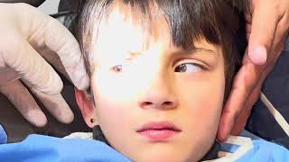 Split Pencil Graphite Safely Extracted from Child’s Ear [upl. by Rowen]