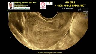 6 weeks A NoN Viable pregnancy [upl. by Guimond]