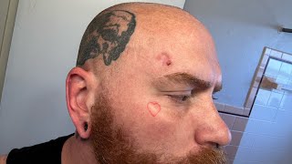 Day 1 Of Superficial Basal Cell Carcinoma Skin Cancer Treatment With Aldara Cream [upl. by Sedaiuqlem793]