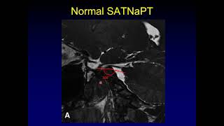 Journal Club Sagittal Angle in Trigeminal Neuralgia [upl. by Faydra]