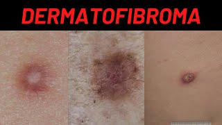 Dermatofibroma Causes Symptoms What is it How is it treated Benign Fibrous Histiocytoma [upl. by Chancelor]