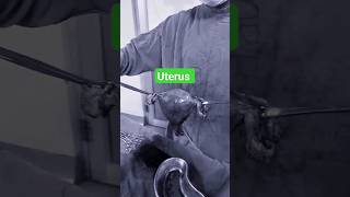 uterus fibroiduterus uterustransplant retroverteduterus shortsfeed shortvideo [upl. by Sirromal661]