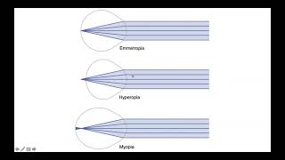 Emmetropia Hyperopia amp Myopia [upl. by Llerrad]