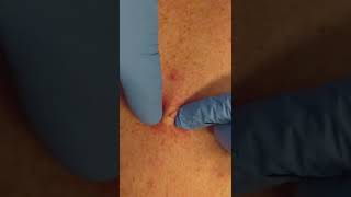 Sebaceous cyst extraction by a dermatologist shorts pimplepopping  CONTOUR DERMATOLOGY [upl. by Anemolihp]